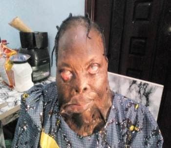 Mrs. Salami after the acid burn, was assisted by Philippo Macedonian Foundation and now needs plastic surgery